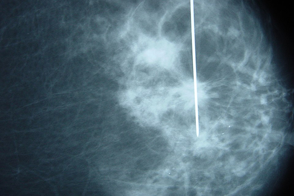 O dia em que me colocaram o arpão 🚑